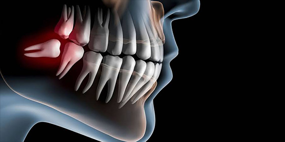 Exodontia de terceiros molares (sisos)